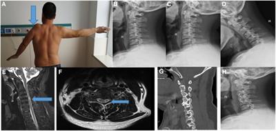 Analysis of surgical treatment of cervical spondylotic amyotrophy